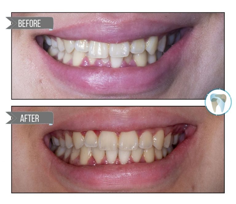 Clear Aligners Before & After: See How They Transform Smiles • Woodhill  Dental Specialties